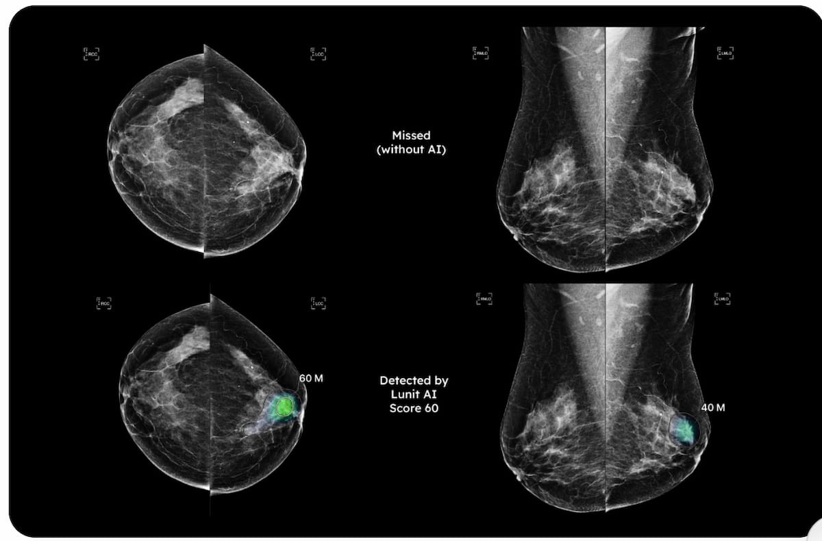 Controversy Over New ACP Breast Cancer Screening Guidelines | Applied ...