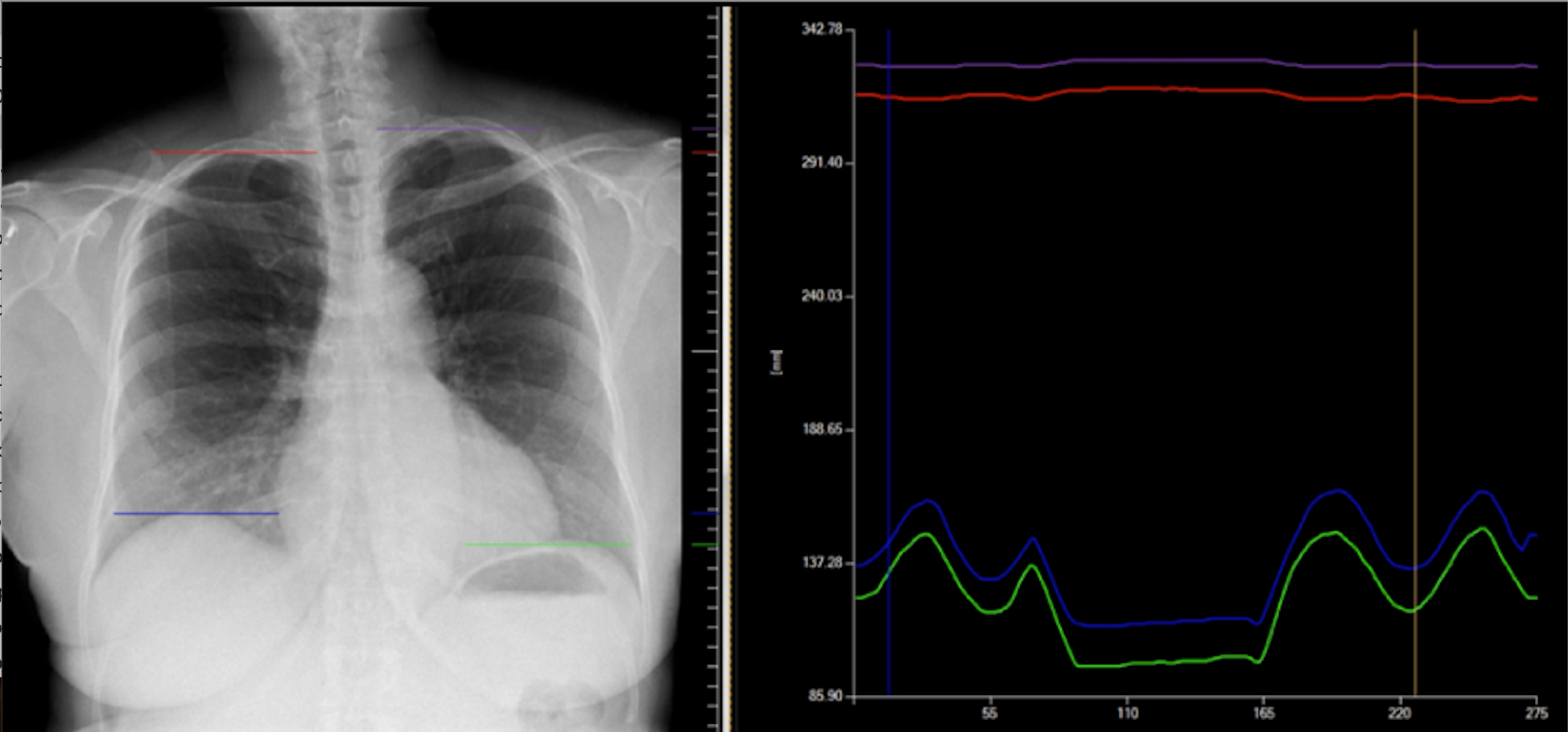 Motion Radiography Konica Minolta | New Imaging Technique Quantifies Shoulder Motion Post ...