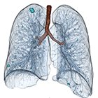 CT-Lung Screening Drives the Need  for Advanced Visualization Tools