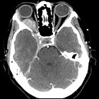 Radiological Case: Orbital pseudotumor with cavernous sinus and sellar extension