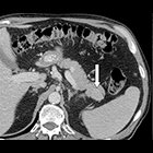 Radiological Case: Intrapancreatic accessory spleen; pancreatic glucagonoma