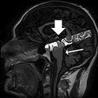 NPH vs. Alzheimer’s disease: Cerebral Spinal Flow Imaging