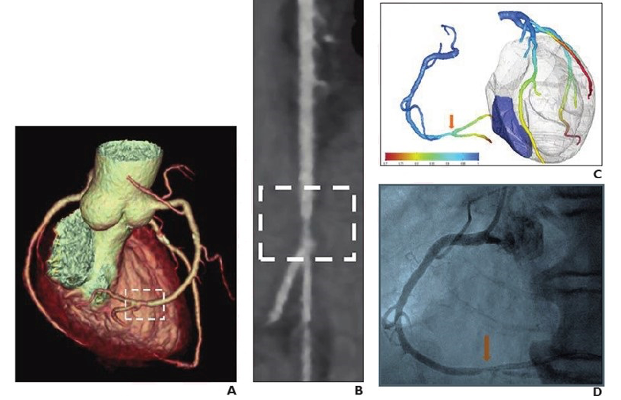 DL-Based, Rapid FFR-CT Algorithm Facilitates Clinical Adoption ...