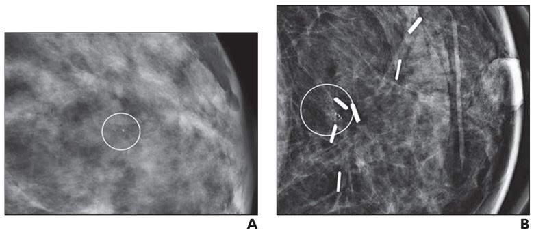 Ten-Year Study Shows DBT Improves Breast Cancer Detection | Applied ...