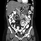 Radiological Case: Non-papillary bladder metastasis from pancreatic adenocarcinoma