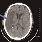 Radiological Case: Lucent MCA sign on head CT after heart valve surgery