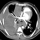 Aortic pseudoaneurysm caused by ingested foreign body