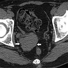 Ectopic ureteral insertion into the seminal vesicle associated with ipsilateral renal dysplasia