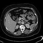 Isolated splenic metastasis in a patient with squamous cell carcinoma of the cervix