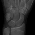 Hook of the hamate fracture