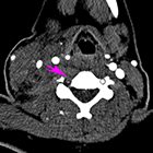 Vertebral artery dissection and Brown-Sequard syndrome resulting from stab wound to the neck