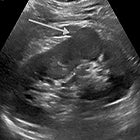 Contrast-enhanced Ultrasound of Renal Masses
