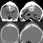 4D-CTA and preoperative embolization of large intraosseous meningioma