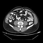 Radiological Case: Mega appendix