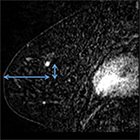 MRI-guided breast interventions