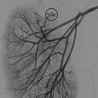 Angiomyolipoma in Tuberous Sclerosis 