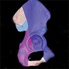 Acetabular fractures: A Stepwise approach to identification and classification on 2D computed tomography