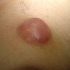 Benign pilomatricoma of the breast