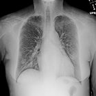 Dual energy subtraction identifies multiple pneumonias