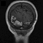 MRI of 75-year-old female with confusion, weakness, speech problems, and visual deficit 