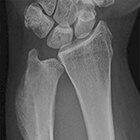 Radiological Case: Osteoblastic osteosarcoma