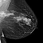 Sclerosing adenosis mimicking malignant lesion on breast MRI