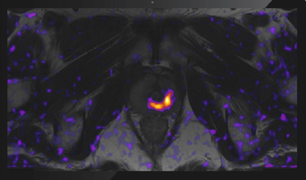 Fully Automated AI Model Detects Prostate Cancer on MRI | Applied Radiology