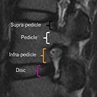 Imaging spinal stenosis