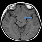 Giant hypothalamic hamartoma