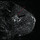 Problem Solving with Breast MRI