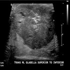 Infantile choriocarcinoma with cutaneous, liver, and lung metastases
