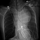 A fatal case of undiagnosed aortic coarctation