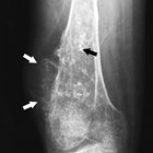 Worrisome and Incidental Signs on Knee Radiographs in Clinical Practice: Malignant Primary Bone Tumors and Benign Bone Lesions