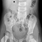 How to Diagnose Intussusception in Children