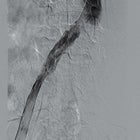 May-Thurner Syndrome