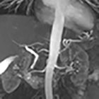 Biliary-hepatic vein fistula in a living donor liver candidate