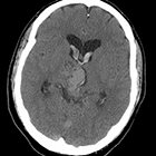Intraventricular hemorrhage secondary to arterial venous malformation