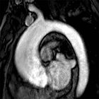 MRI of the thoracic aorta