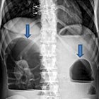 Radiological Case: A rare case of left colonic obstruction—cloth fiber bezoar