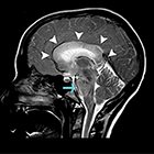 MRI of Toxic, Metabolic, and Autoimmune Encephalopathies: A Review