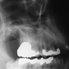 Imaging Torus Lesions of Jaw Bones