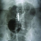 Giant Sigmoid Diverticulum: Imaging Features and Management
