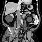 Primary venous leiomyosarcoma: Cross-sectional imaging modalities, including CT, MRI, and F18-FDG PET/CT