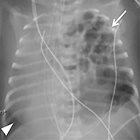 Postoperative Congenital Diaphragmatic Hernia: What the Radiologist Needs to Know