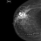 Primary osteosarcoma of the breast