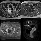 MRI classification and characterization of complex ovarian masses