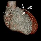 Cardiac CT angiography: Patient-centric low-dose imaging