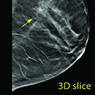 Contrast-enhanced Mammography: Successful Clinical Experience