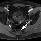 Musculoskeletal Findings on Prostate MRI: Beyond Metastases