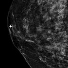 Invasive breast cancer: Digital breast tomosynthesis versus full-field digital mammography